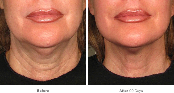 Cool Sculpting By Zeltiq: Cosmetic Dermatology Walnut ...